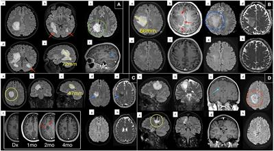 Phenotyping variants of tumefactive demyelinating lesions according to clinical and radiological features—A case series